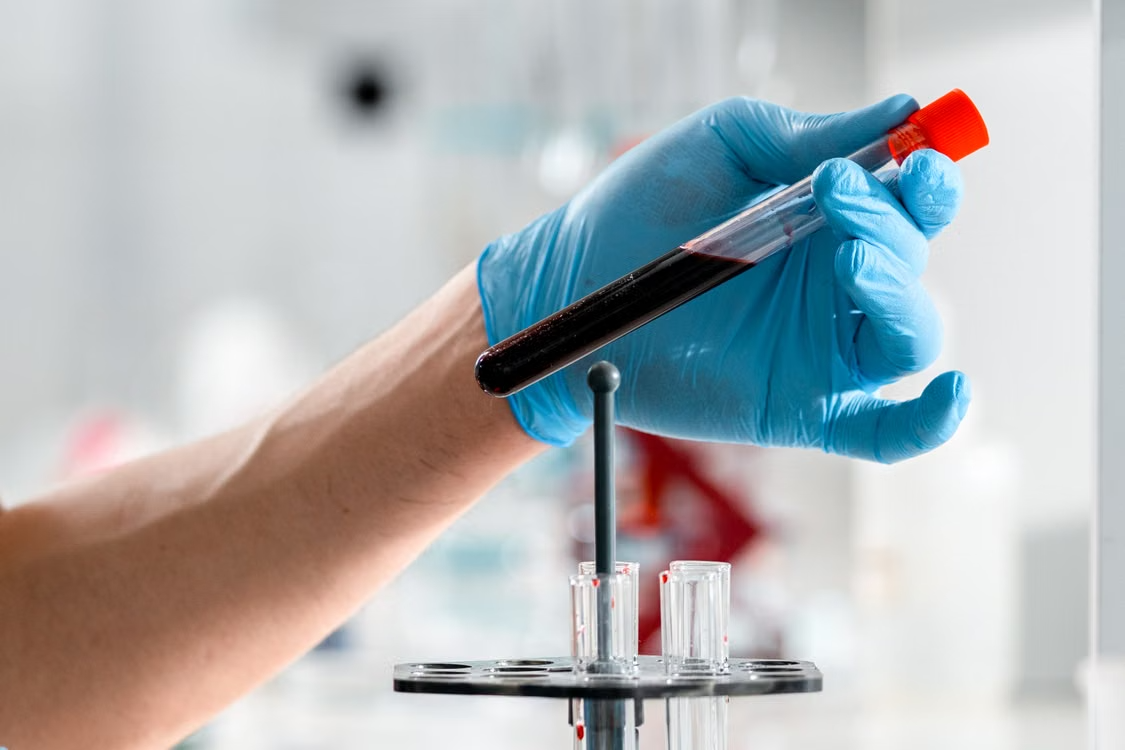 Exame de sangue para avaliar síndrome metabólica